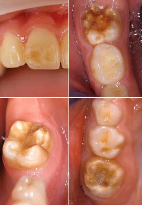 MOLAREN-INZISIVEN-HYPOMINERALISATION (MIH) MOLAREN-INZISIVEN-HYPOMINERALISATION (MIH)