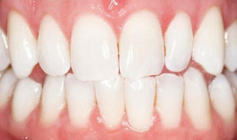 ZAHNAUFHELLUNG (BLEACHING) ZAHNAUFHELLUNG (BLEACHING)