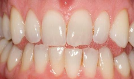 ZAHNAUFHELLUNG (BLEACHING) ZAHNAUFHELLUNG (BLEACHING)