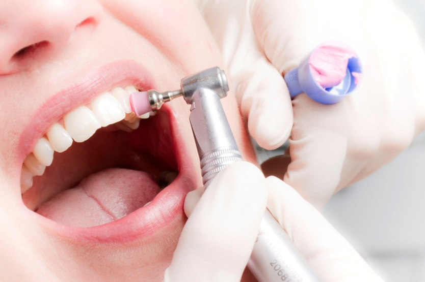 MUNDHYGIENE - PROPHYLAXESITZUNG MUNDHYGIENE - PROPHYLAXESITZUNG