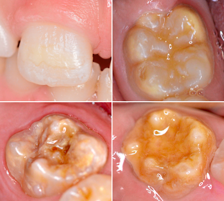 Molaren-Inzisiven-Hypomineralisation (MIH)